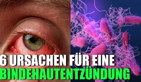 6 Ursachen für Anal Schmerzen 